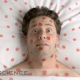 New Research Links Stress and Acne